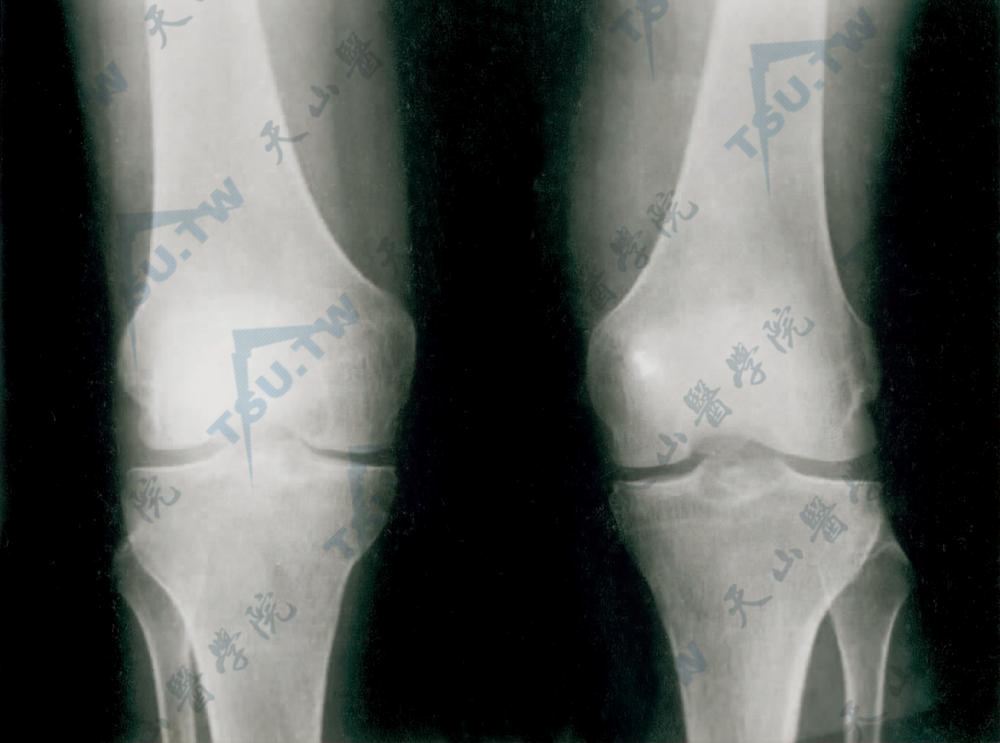 多中心网状组织细胞增生症症状：双膝关节骨质破坏