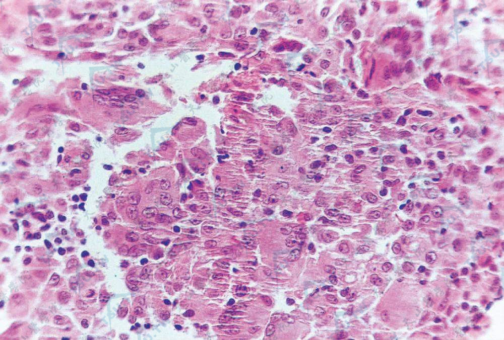 网状组织细胞肉芽肿：真皮大量组织细胞及多核组织细胞，胞质呈毛玻璃状（HE染色×400）