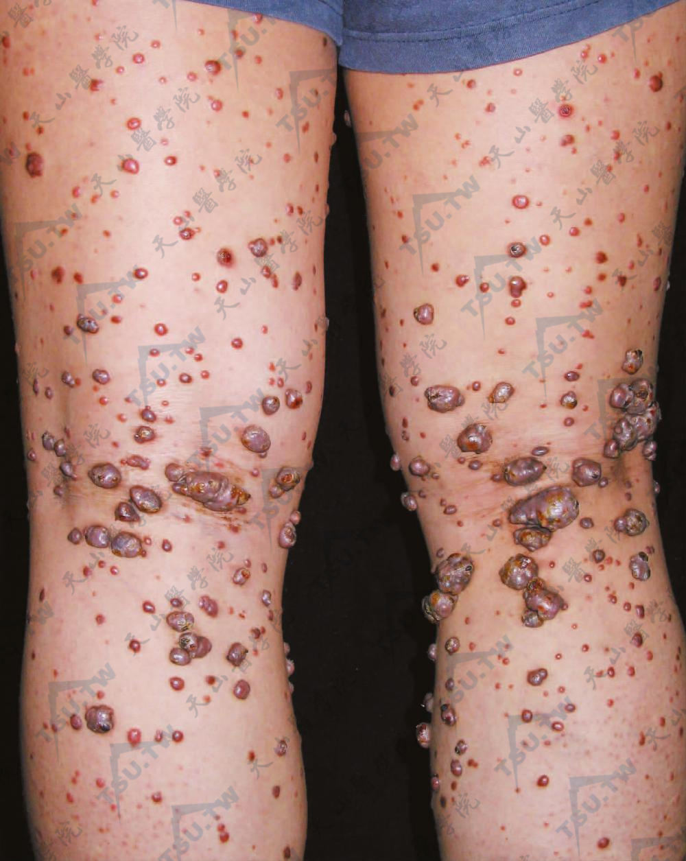 进行性结节性组织细胞瘤：双下肢后部可见许多大小不一的暗紫红色丘疹和结节（肉豆）