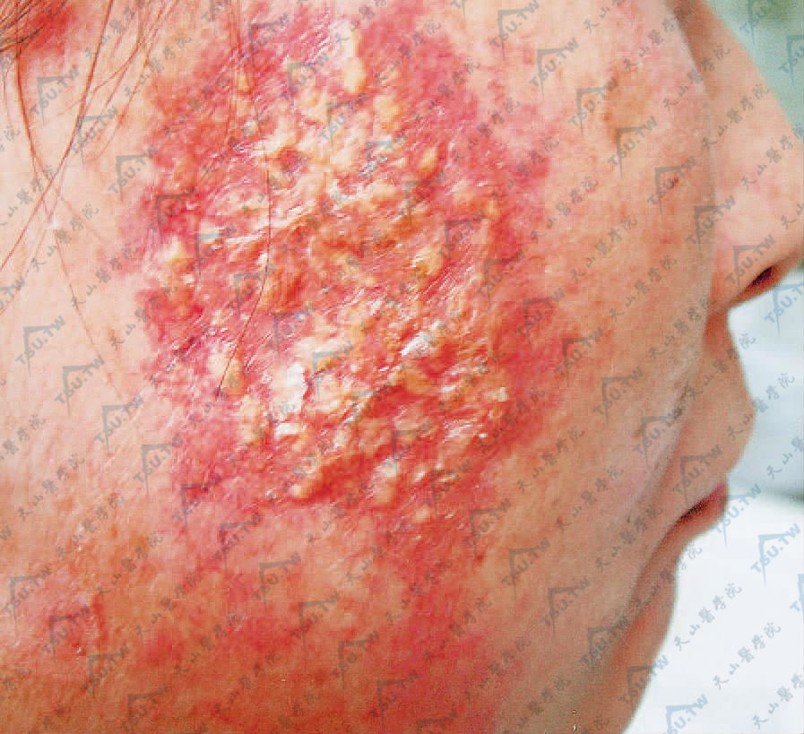 皮肤窦性组织细胞增生症　右面部有一暗红色斑块，边界尚清，其上散在粟粒至绿豆大黄色丘疹，边缘毛细血管扩张