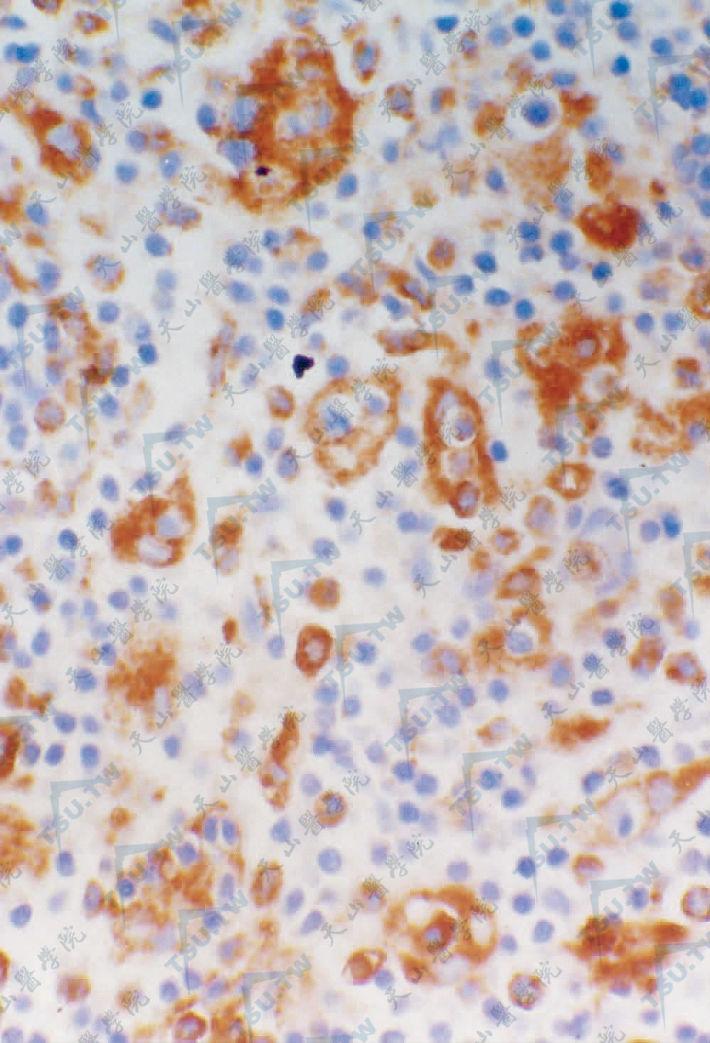 组织细胞CD68染色阳性，胞质内见淋巴细胞（Envision法×400）