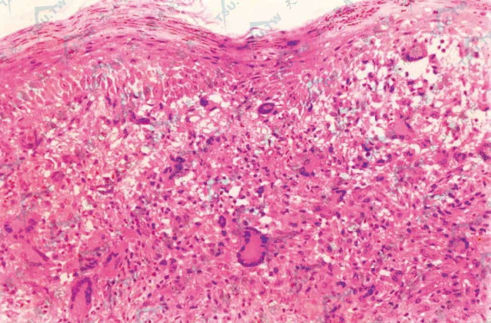 幼年性黄色肉芽肿组织病理学改变：肉芽肿内多量组织细胞、Tonton巨细胞及少量淋巴细胞