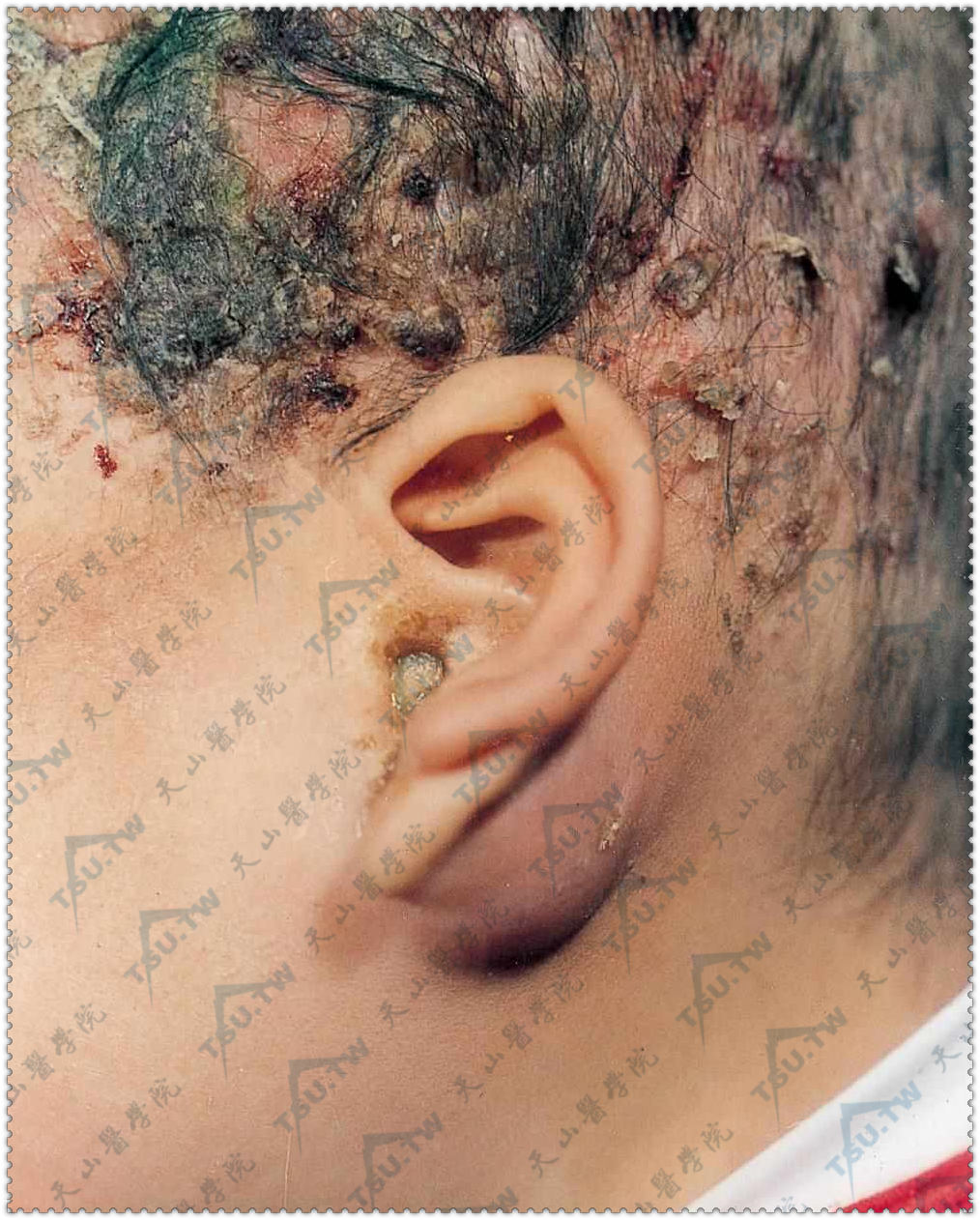 朗格汉斯细胞组织细胞增生症：头部脂溢性皮炎样皮损，左耳后乳突部红肿，外耳道溢脓