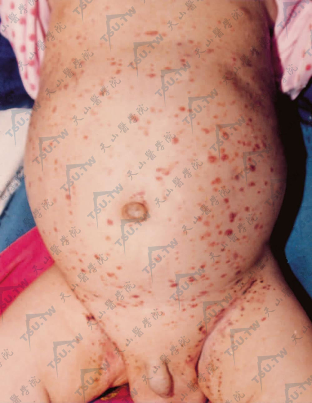 朗格汉斯细胞组织细胞增生症婴儿患者：婴儿躯干部发生群集的黄棕色鳞屑性斑丘疹，有的可呈紫癜状，分布广泛