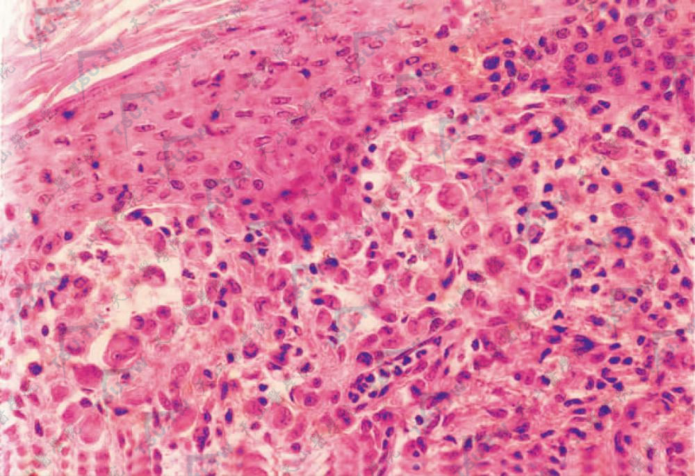 朗格汉斯细胞组织细胞增生症组织病理学改变：浸润的组织细胞胞体圆大，胞质丰富，淡伊红色，侵及表皮