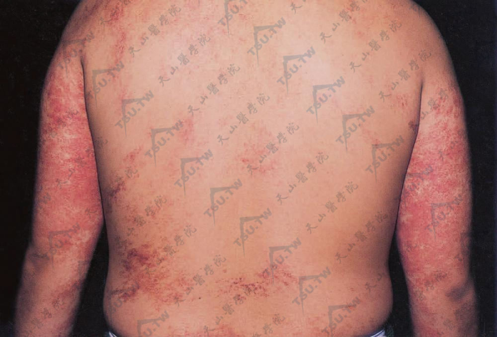 匍行性血管瘤（Angioma Serpiginosum）患者：双上肢和背部散在分布许多暗红色斑，部分区域皮损有簇集现象