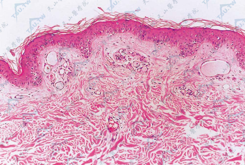 匍行性血管瘤组织病理学改变：真皮乳头和网状层的浅层有扩张和增生的毛细血管
