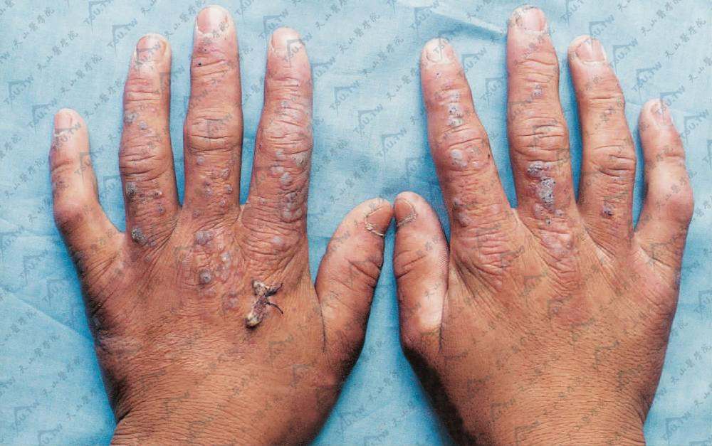 肢端血管角化瘤（Angiokeratoma Acroasphyticum）手部症状