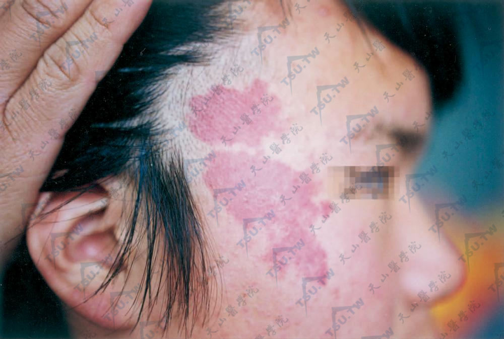 鲜红斑痣（毛细血管扩张痣）患者面部症状：左颞部至发际鲜红色斑片边缘不整