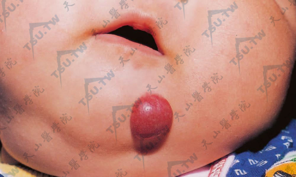 毛细血管瘤（Capillary Hemangioma）的患者表现