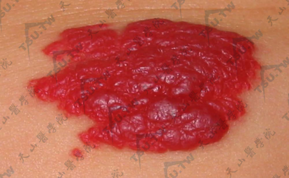 毛细血管瘤（Capillary Hemangioma）症状：左胸部可见一片鲜红色、略高出皮面的分叶状肿瘤，边界清楚