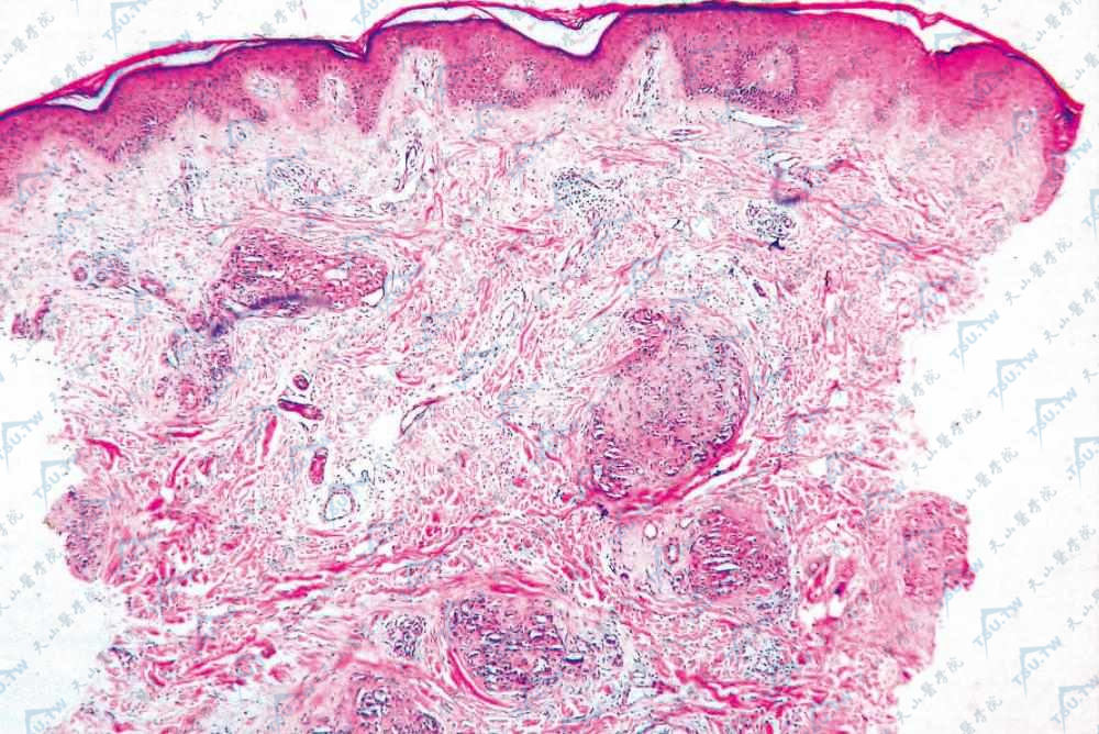 丛状血管瘤（Tufted Angioma）组织病理学改变