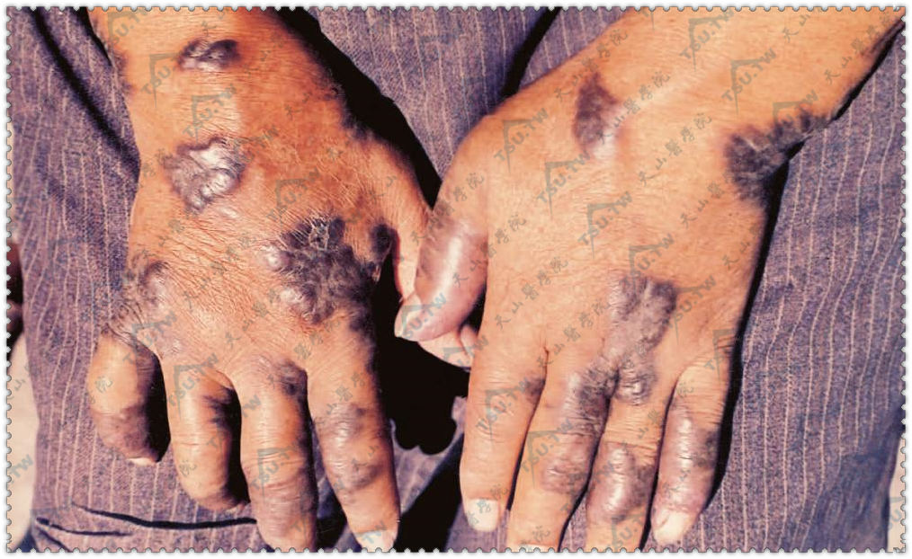 卡波西肉瘤（Kaposi肉瘤）患者手部症状：手、前臂等处出现淡红色、淡蓝色、青红色或紫色斑块和结节。硬如橡皮，表面及周围有毛细血管扩张