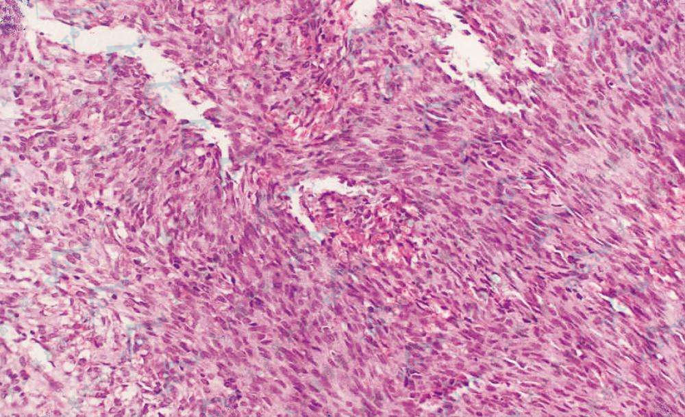 卡波西肉瘤（Kaposi肉瘤）皮肤组织病理学改变：梭形细胞平行排列，条索状形成腔隙，腔隙内有红细胞