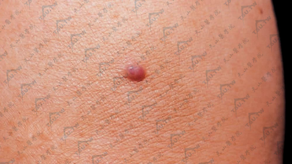 血管球瘤（球状血管瘤）患者右上肢近端伸侧可见绿豆大小紫红色结节，质中偏软