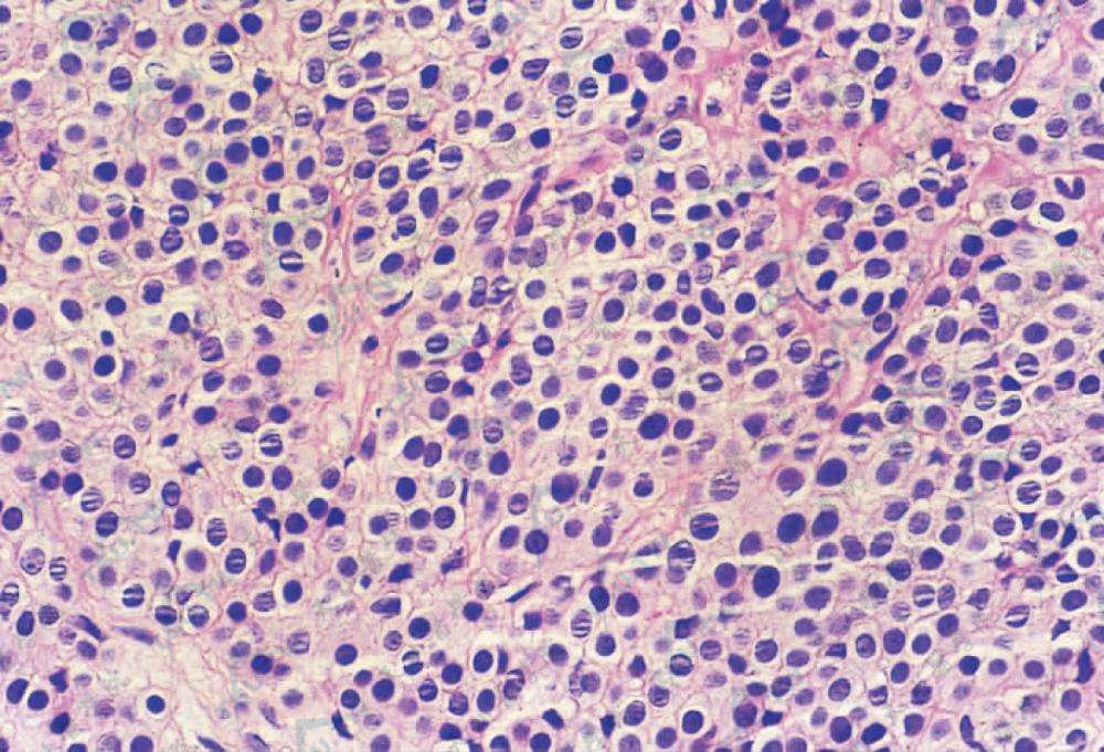 血管球瘤（球状血管瘤）皮肤组织病理学改变：肿瘤细胞大小形态一致，圆形或立方形，胞质淡红透明，胞核大而圆