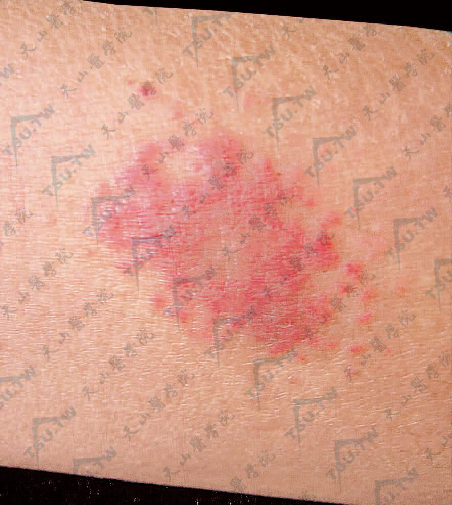 血管外皮细胞瘤（Hemangiopericytoma）患者症状：左前臂暗红色斑块，周围散在丘疹
