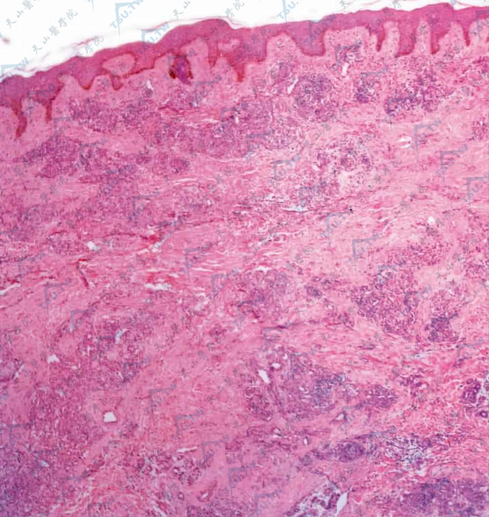 血管外皮细胞瘤（Hemangiopericytoma）皮肤组织病理学改变