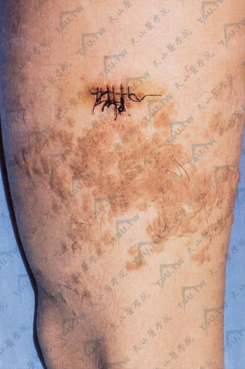 浅表脂肪瘤样痣症状：大腿部皮损为群集性，柔软扁平丘疹或结节，正常肤色或淡黄色，表面光滑或有褶皱