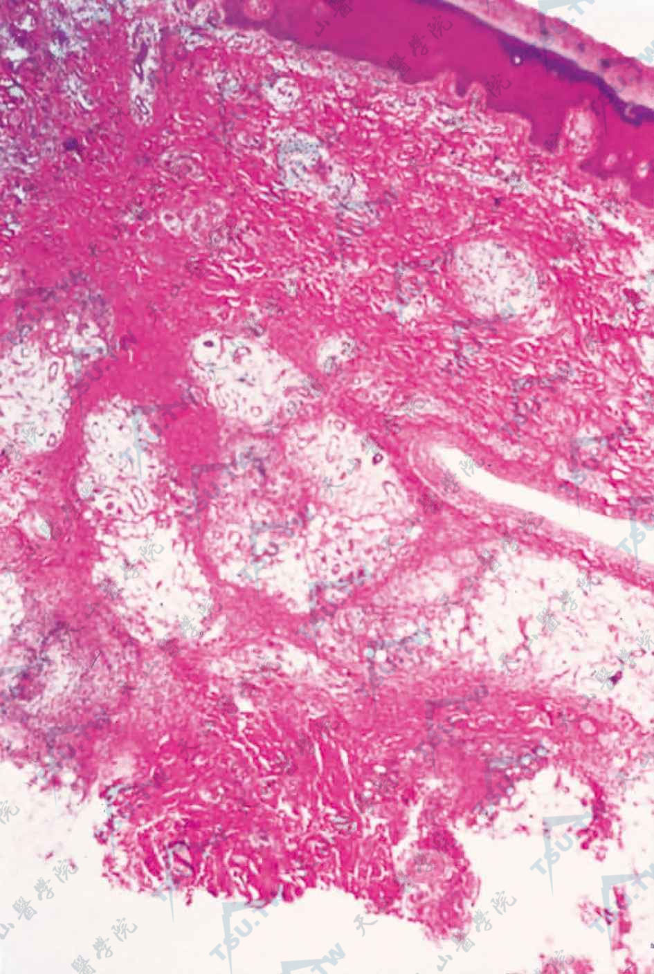 浅表脂肪瘤样痣组织病理学改变：真皮中上部散在小灶性脂肪细胞（HE染色×100）