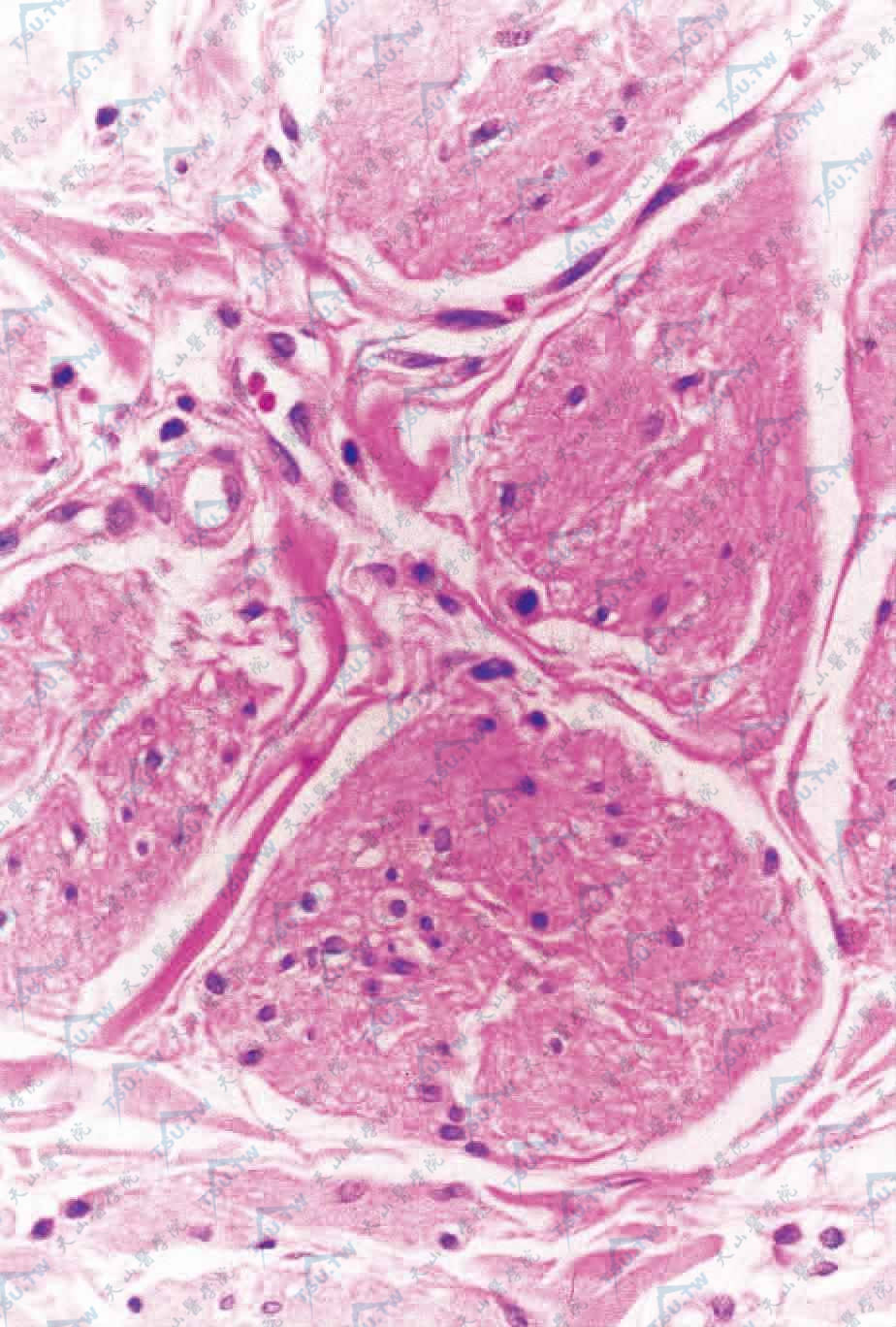 真皮网状层平滑肌细胞核周可见空泡（HE染色×400）