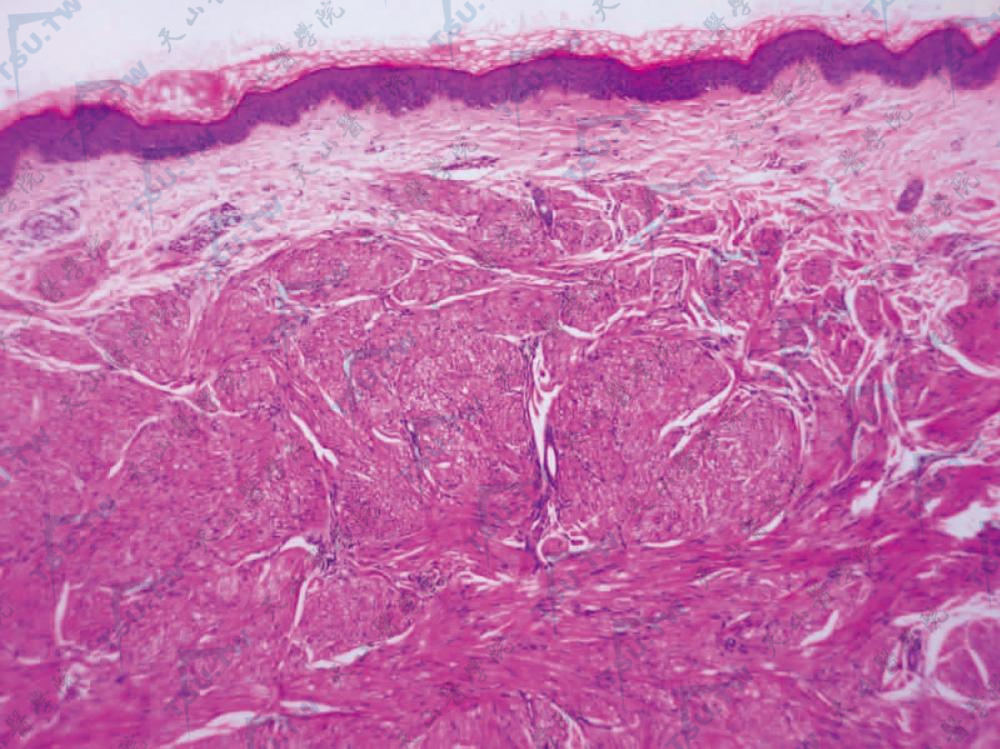 平滑肌瘤（Leiomyoma）组织病理学改变