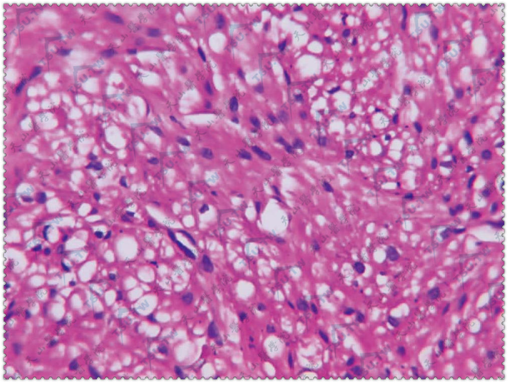 平滑肌瘤（Leiomyoma）肿瘤团块由不同走向的平滑肌构成（HE染色×400）