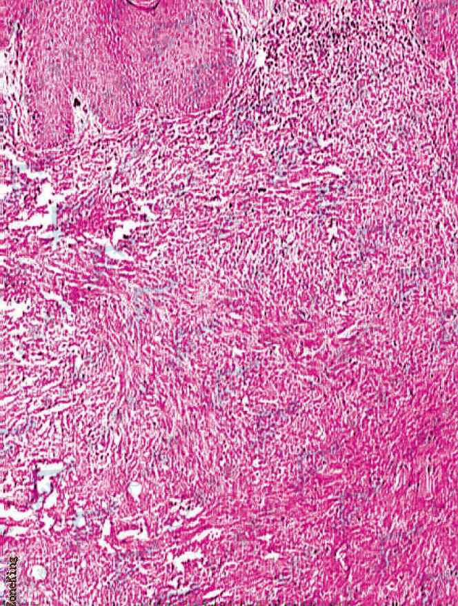 平滑肌肉瘤（Leiomyosarcoma）组织病理学改变