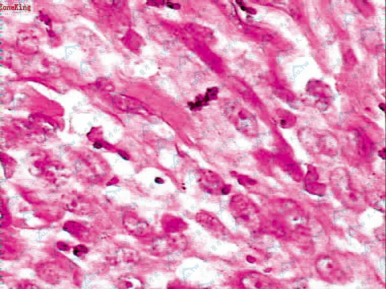 平滑肌肉瘤：许多梭形细胞，核呈杆状，两端钝圆，可见病理性核分裂象及灶状坏死（HE染色×400）