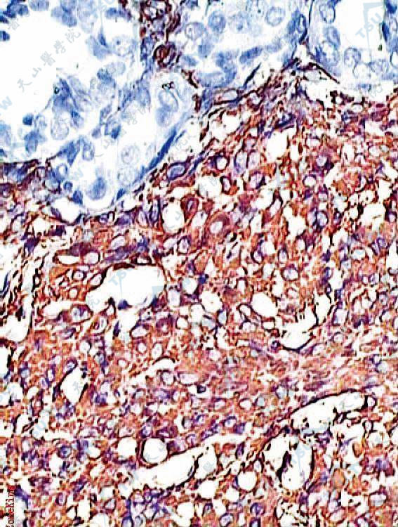 平滑肌肉瘤：梭形肿瘤细胞胞质呈棕黄色，vimentin呈强阳性反应（SP法染色×200）