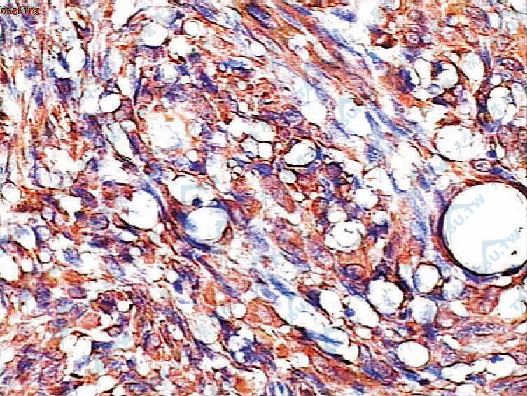 平滑肌肉瘤：部分梭形肿瘤细胞核呈棕黄色，SMA呈强阳性反应（SP法染色×400）