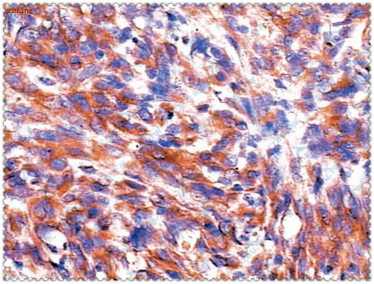 平滑肌肉瘤：肿瘤细胞胞质呈淡棕黄色，CD34呈阳性反应（SP法染色×400）