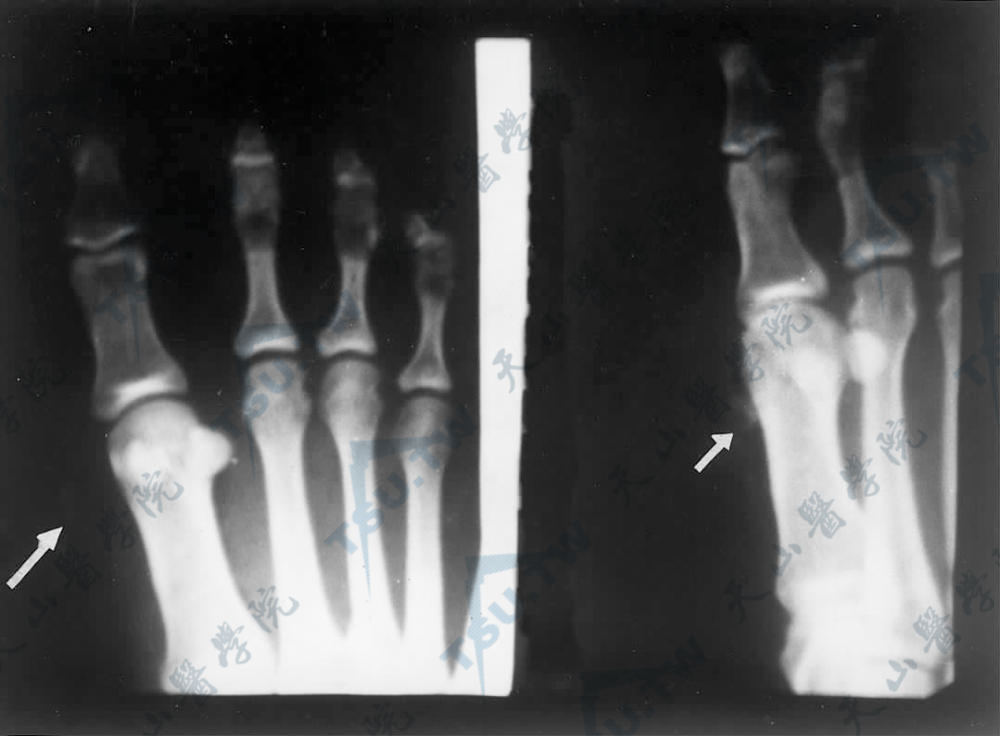化生性骨化：右足X线影像示正、斜位片见第一跖骨旁有钙化影
