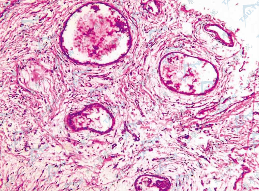 皮肤子宫内膜异位（Cutaneous Endometriosis）管壁细胞胞质及管腔内无定形物质红染（PAS染色×100）