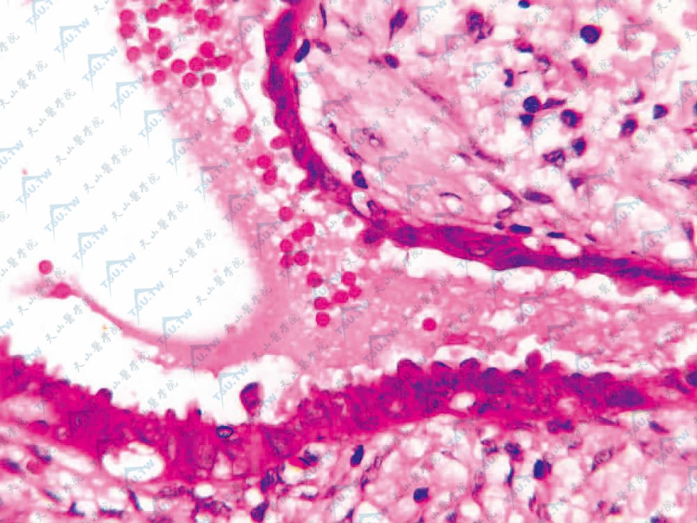 腺样管腔内见断头分泌（HE染色×400）