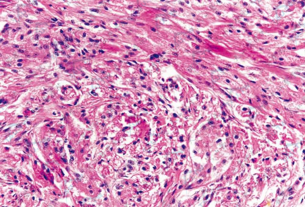 颗粒细胞瘤：瘤细胞体积大，胞质丰富，淡染，充满嗜酸性颗粒