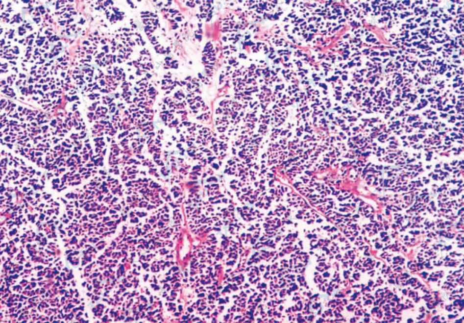 梅克尔细胞癌（柱状癌）病理学改变：瘤细胞成片状或条索状相互交织（HE染色×100）