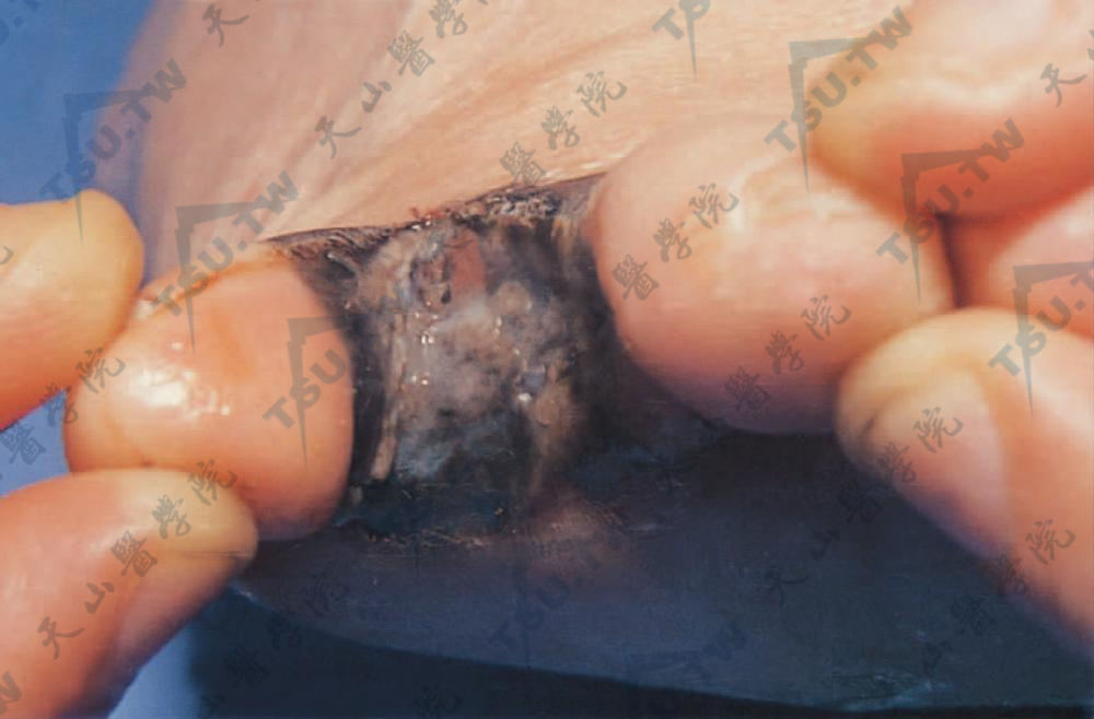 脚趾部位肢端黑素瘤症状：病变发生在趾间，呈黑色结节，蕈样溃疡