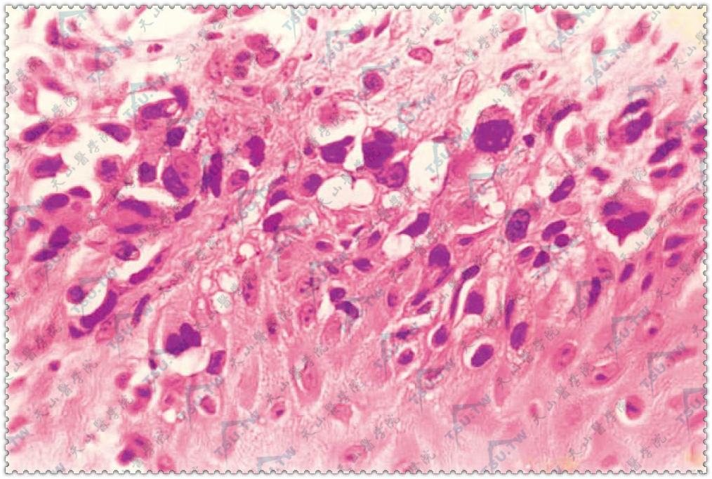 原位恶性黑素瘤病理表现：表皮基底部瘤细胞核大，深染，形态不规则，少量黑素，基底膜完整