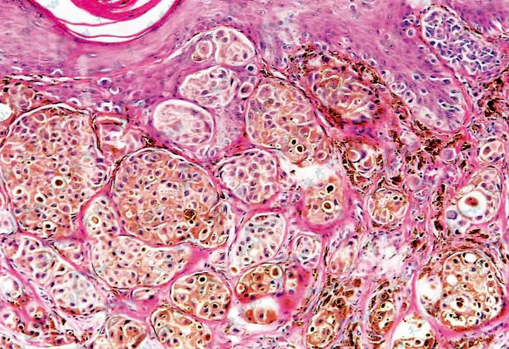 气球状细胞和透明细胞黑素瘤组织病理：肿瘤细胞体积大，胞质丰富，呈气球状（HE染色×200）