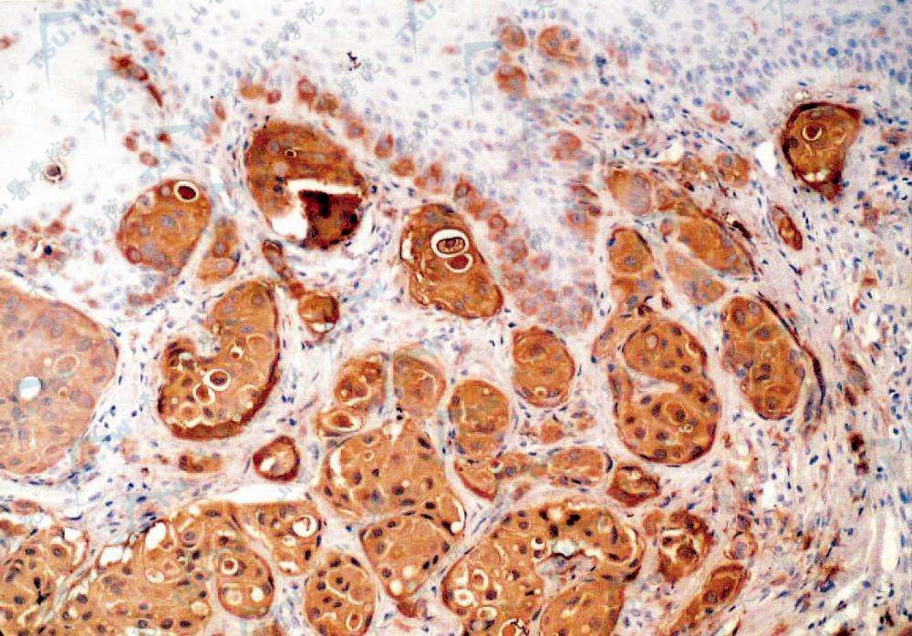 肿瘤细胞胞质S-100蛋白阳性表达，胞质呈棕黄色（SP法×200）