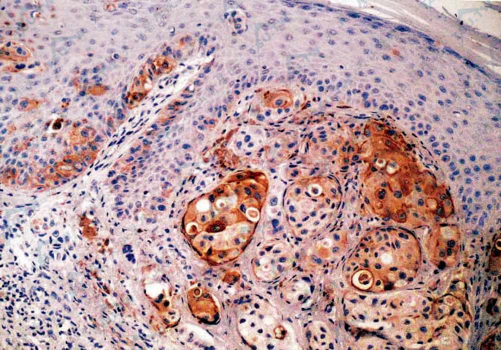 气球状细胞恶性黑素瘤　肿瘤细胞胞质HMB-45阳性表达，胞质呈棕黄色（×200）