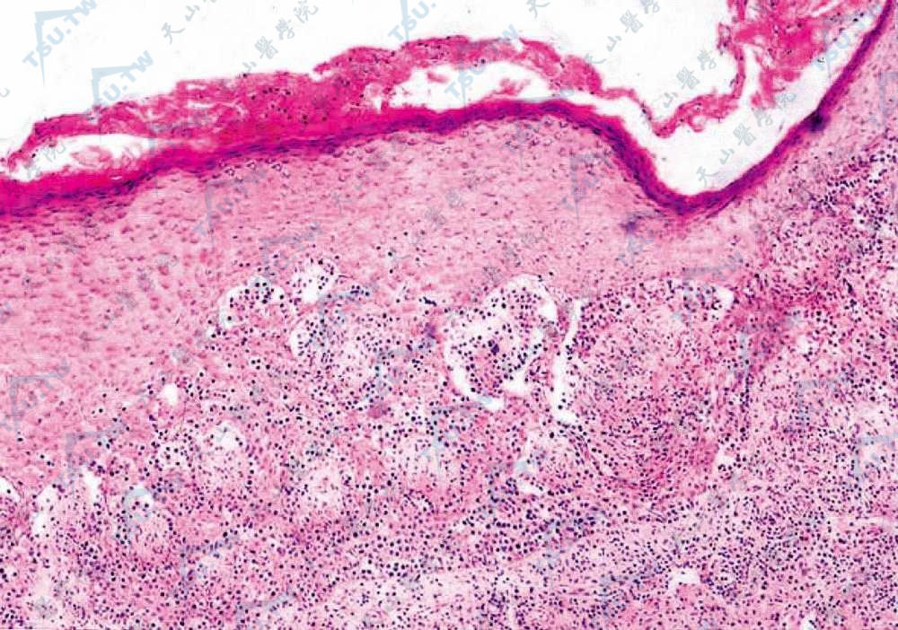 表皮下部和真皮上部可见不典型单核细胞浸润，多个细胞聚集成巢，似Pautrier微脓肿