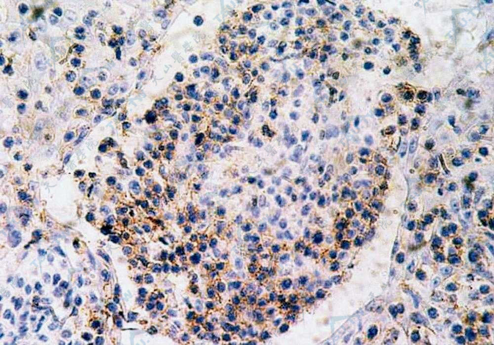 细胞质CD3＋，呈棕黄色（IHC染色×400）
