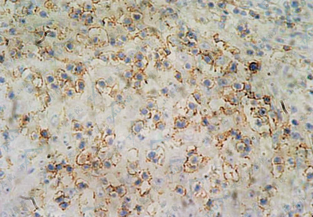 细胞膜CD43＋，呈棕黄色（IHC染色×400）
