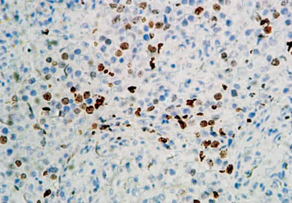 细胞核Ki-67阳性，呈棕黄色（IHC染色×400）