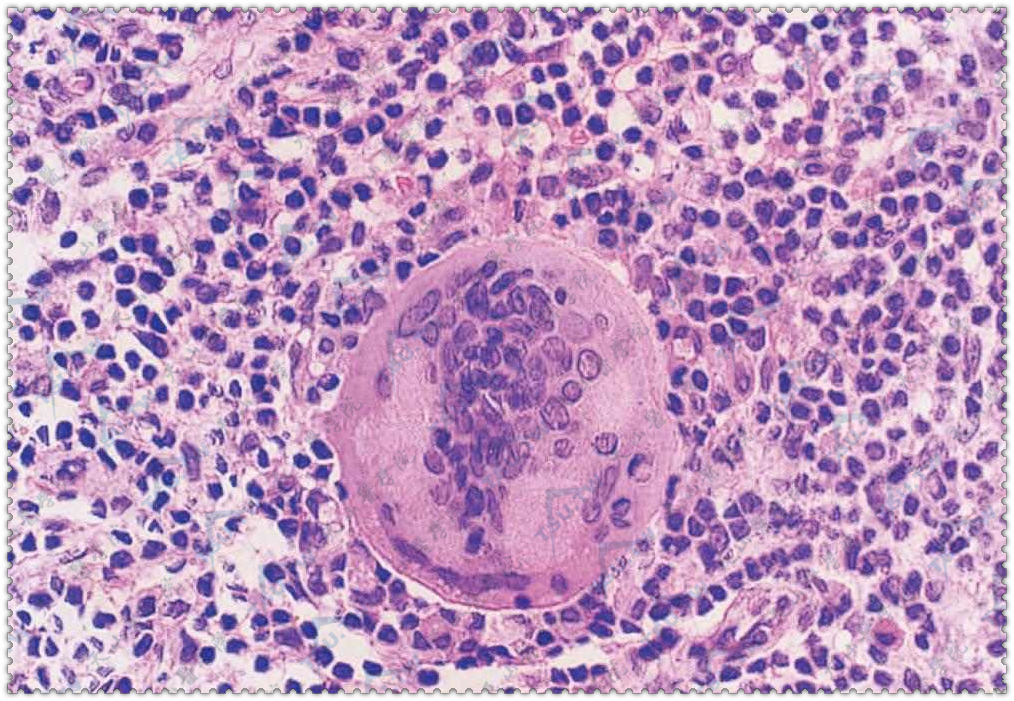 示淋巴组织细胞及巨大多核巨细胞（HE染色×200）