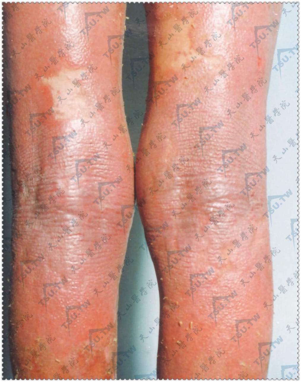 塞扎里综合征，双下肢红皮病样改变