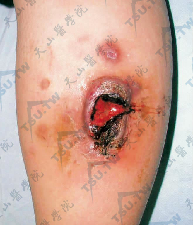 原发性皮肤CD30＋间变性大细胞淋巴瘤症状：右小腿屈侧见一溃疡，边缘呈堤状，附近有数个结节和紫色斑