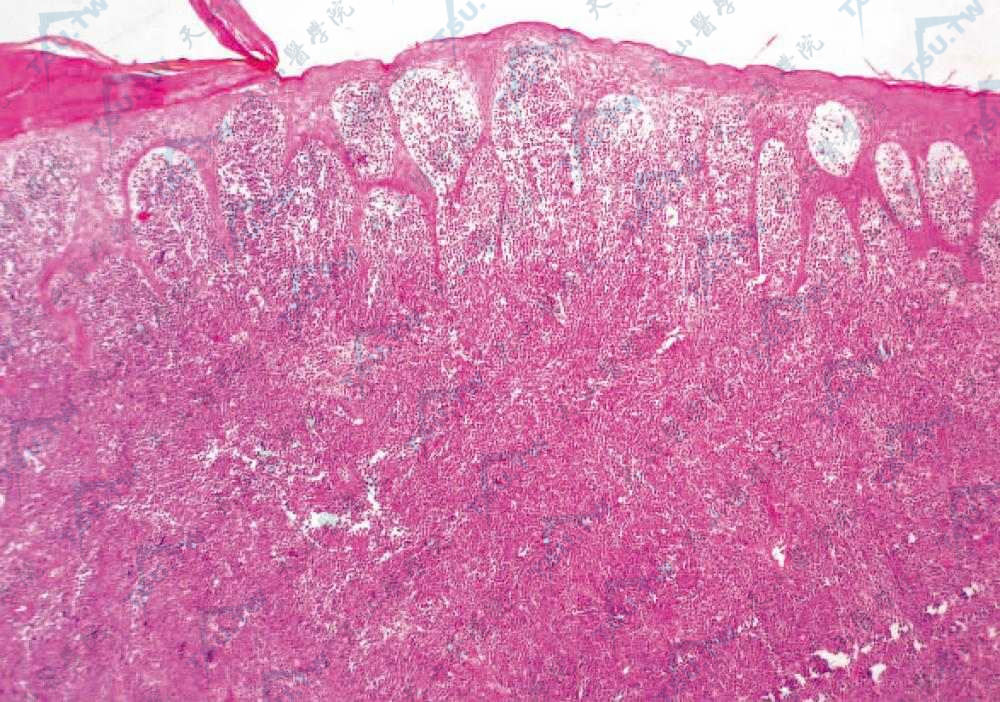 原发性皮肤CD30＋间变性大细胞淋巴瘤病理：表皮突延长，肿瘤细胞密集浸润于真皮全层